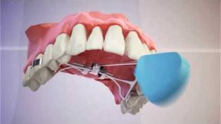 The Vecs™ Rapid Palate Expander [upl. by Griffin]