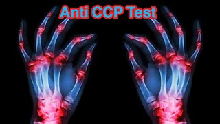 What does antiCCP positive mean  What is antiCCP normal range  Anti CCP Test [upl. by Garlaand]