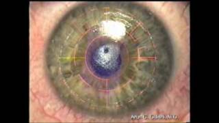 Keratoconus Correction Gulani Keratoconus Surgeries Think Beyond the quotCONEquot [upl. by Jansson]