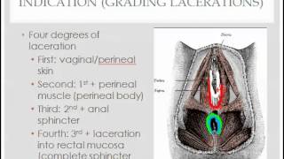 perineal laceration repair  description indications and questions [upl. by Charmian]