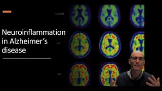 Neuroinflammation in Alzheimers Disease The Role of Microglia [upl. by Naegem]