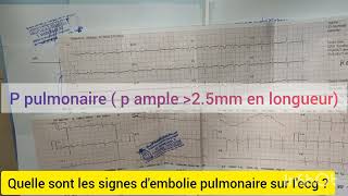 QUELLE SONT LES SIGNES DEMBOLIE PULMONAIRE SUR LECG CAS PRATIQUE [upl. by Affer]