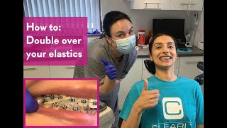 How to Double over your elastics  Clearly Orthodontics [upl. by Schweiker144]