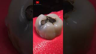 Restauración dental tipo inlay satisfying [upl. by Lambard]