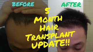 5 Month Hair Transplant Update w Before Pictures [upl. by Yuzik453]