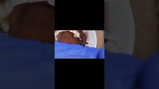 Molar implants 4 month post op osseointesratun  Tapping sound [upl. by Maise328]