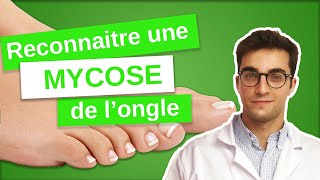 Savoir RECONNAÎTRE une MYCOSE de longle  Onychomycose 13 [upl. by Krefetz]