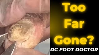 Too Far Gone Severe Fungal Toenails [upl. by Aerdnaz]