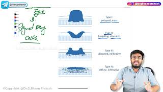 10 Gastric tumours  Benign and Malignant   USMLE Step 1 Pathology [upl. by Walkling]