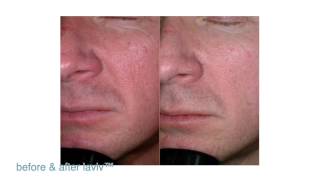 FDAApproved LaViv Fibroblast Treatment  Maryland Laser Skin amp Vein [upl. by Lotta]