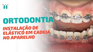 Dica de Ortodontia Como instalar o Elástico em Cadeia no Aparelho de 1o molar a 1 molar inferior [upl. by Ecnerual]