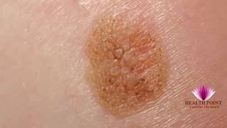 Melanoma Pictures  Signs Symptoms Causes Photos Images Pictures of Melanoma Skin Cancer [upl. by Burrton]