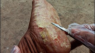 Ultimate Foot Scraping Transformation for an Australian Man [upl. by Roanna939]