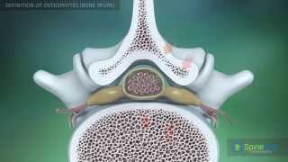 Osteophytes bone spurs Definition [upl. by Kennet338]