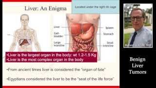 BENIGN NONCANCEROUS LIVER TUMORS by Dr Robert Gish [upl. by Publea865]