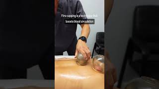 Fire Cupping Would You Try This [upl. by Annaj]