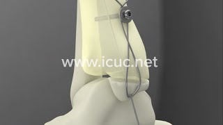 Medial Malleolus ORIF  ICUC® Video [upl. by Tarrah]