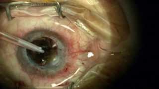 Complex Corneal Transplantation Cataract Surgery Synechialysis [upl. by Phyllida]