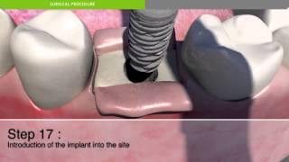 Surgical procedure for placement of a dental implant [upl. by Pantia539]