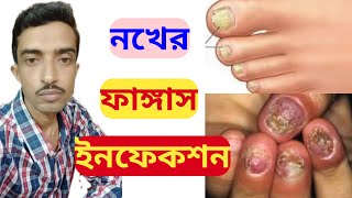 Nail Fungus Infection Treatment In Bengali  Homeopathic Medicines For Nail Fungus  Bangla [upl. by Aissej]