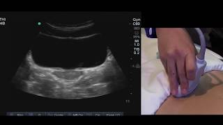 How to find Ovaries on Transabdominal Ultrasound [upl. by Alrak]