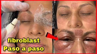 Fibroblast o fibropen paso a paso y su efecto secundario [upl. by Relyks]