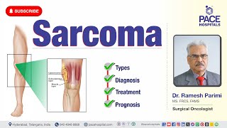 Sarcoma Cancer  Types Diagnosis Treatment amp Prognosis  sarcomatreatment [upl. by Myrah]