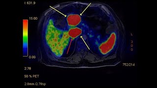 Signs you may have a pancreatic neuroendocrine tumor  Mayo Clinic [upl. by Uella]