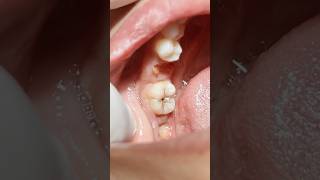 Print technique composite restoration for lower second molar tooth [upl. by Chassin405]