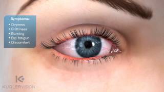 LipiFlow Dry Eye Treatment Educational Video from Kugler Vision [upl. by Yonatan]