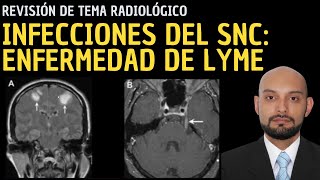 Radiología en 5 minutos Infecciones del sistema nervioso central Enfermedad de Lyme [upl. by Notsnhoj]