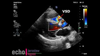 Ventricular Septal Defect VSD echocardiography echo congenital heart disease [upl. by Nylecoj]