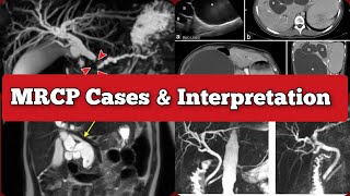 Radiology Viva Cases  137138  MRCP Primary Sclerosing Cholangitis medical radiology doppler [upl. by Amluz]