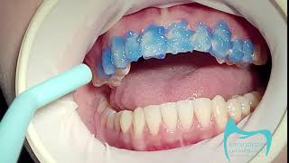 فينير فلدسباثك بدون حف اسنان Feldspathic veneers without teeth grinding [upl. by Eerrehc]