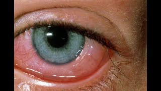 Conjunctivitis  Different types [upl. by Aseen]