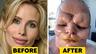 15 Times Plastic Surgery Went Horribly Wrong [upl. by Greenland]