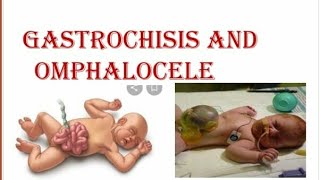 Gastroschisis and Omphalocele [upl. by Carpio155]