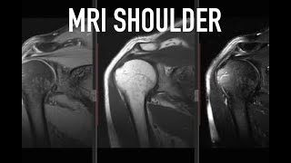 MRI Shoulder [upl. by Ursulina181]