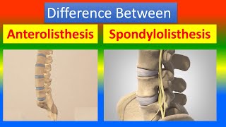 Distinction Between Anterolisthesis and Spondylolisthesis [upl. by Yornoc]