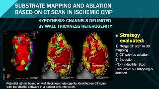 PR2023 MARCH 20  Ablation of ventricular arrhythmias 3 [upl. by Akirre817]