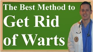 The Best Method to Get Rid of Warts at Home [upl. by Ahsetan]