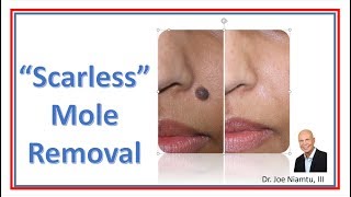 Mole Removal the Easy Way [upl. by Putscher]