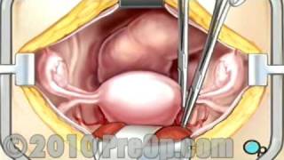 PreOp® Patient Education Hysterectomy Removal of the Uterus [upl. by Ylecic]