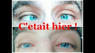 Lendemain doperation du strabismeTOUT VA BIEN strabismus operation [upl. by Gaylene]