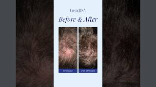 Revolutionary Antihair loss tonic beforeamp after cosmerna [upl. by Emile]