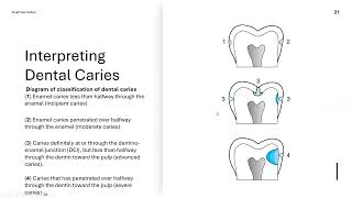 Bitewing Radiographs and their Interpretation [upl. by Adabelle]