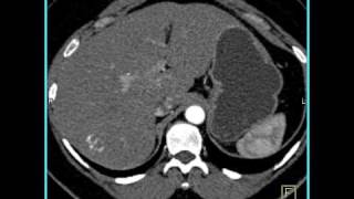 Abdomen Liver Hemangioma of the Liver1 of 8 [upl. by Herrick]