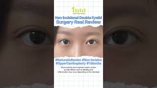 Nonincisional Double Eyelid Surgery Real Review at 1mm Plastic Surgery plasticsurgery [upl. by Sontich]