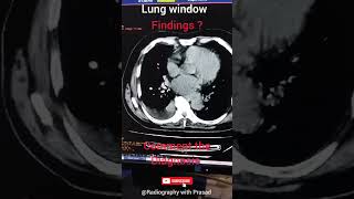 HRCT THORAX MEDIASTINUM WINDOW  HRCT THORAX FINDINGS  THORAX CT SCAN [upl. by Jorin]