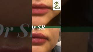 lip filler  correction of asymmetry [upl. by Lusar]